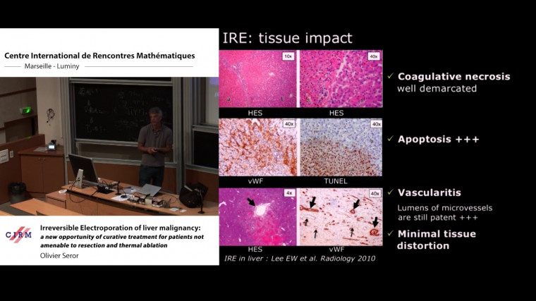 Irreversible electroporation of liver malignancy: a new opportunity of curative treatment for patients not amenable to resection and thermal ablation